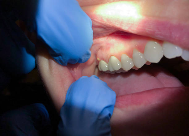 Best Emergency Dental Extractions in Daleville, IN
