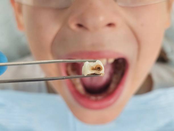 Best Emergency Dental Care for Abscessed Tooth in Daleville, IN
